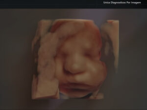 Ultrassonografia Obstétrica 4D HD Live (16)