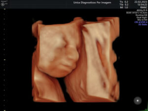 Ultrassonografia Obstétrica 4D HD Live (17)
