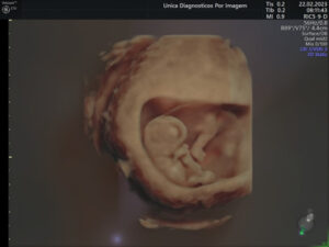 Ultrassonografia Obstétrica 4D HD Live (20)