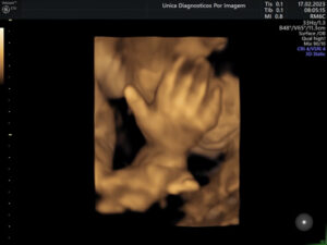 Ultrassonografia Obstétrica 4D HD Live (22)