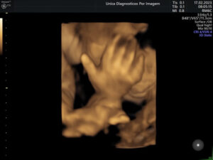 Ultrassonografia Obstétrica 4D HD Live (23)