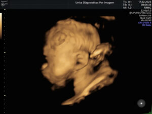 Ultrassonografia Obstétrica 4D HD Live (24)