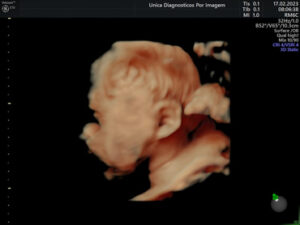 Ultrassonografia Obstétrica 4D HD Live (25)