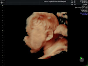 Ultrassonografia Obstétrica 4D HD Live (26)