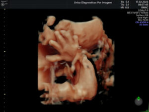 Ultrassonografia Obstétrica 4D HD Live (27)