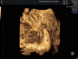 Ultrassonografia Obstétrica 4D HD Live (28)