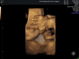 Ultrassonografia Obstétrica 4D HD Live (30)