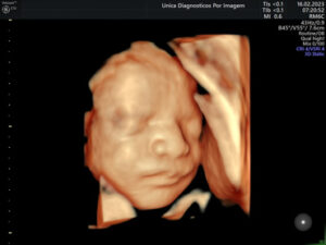Ultrassonografia Obstétrica 4D HD Live (31)
