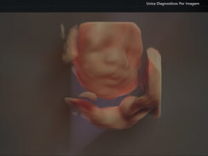 Ultrassonografia Obstétrica 4D HD Live (35)