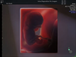 Ultrassonografia Obstétrica 4D HD Live (43)