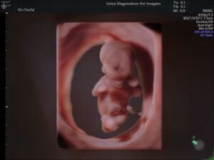 Ultrassonografia Obstétrica 4D HD Live (44)