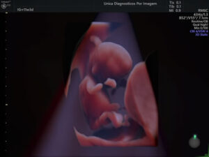 Ultrassonografia Obstétrica 4D HD Live (45)