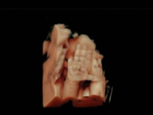 Ultrassonografia Obstétrica 4D HD Live (46)