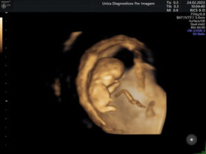 Ultrassonografia Obstétrica 4D HD Live (5)