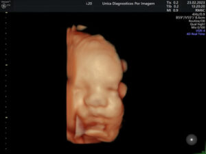 Ultrassonografia Obstétrica 4D HD Live (7)
