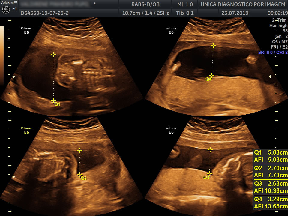 Ultrassom Obstétrico