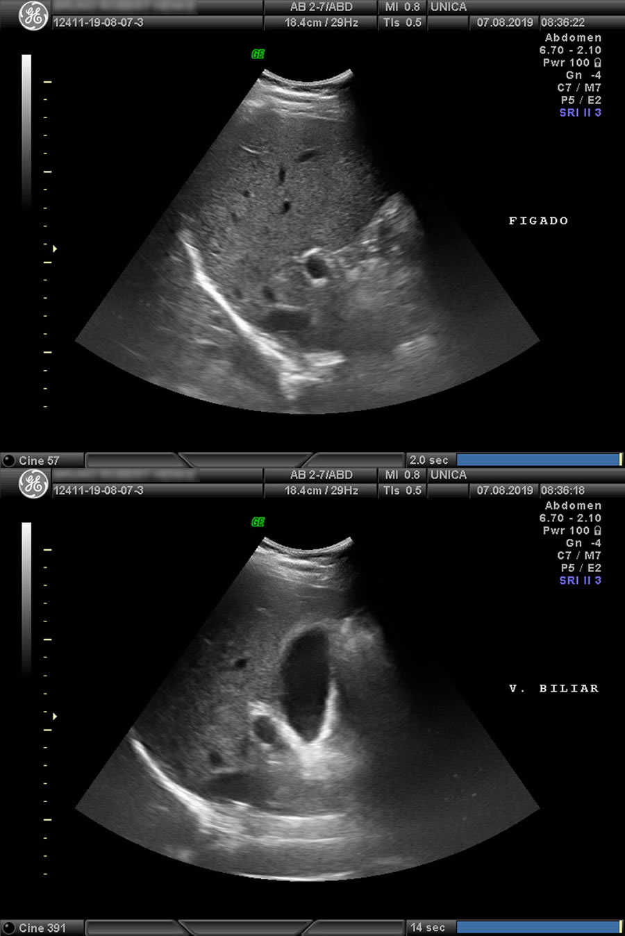 Ultrassom Abdominal Total