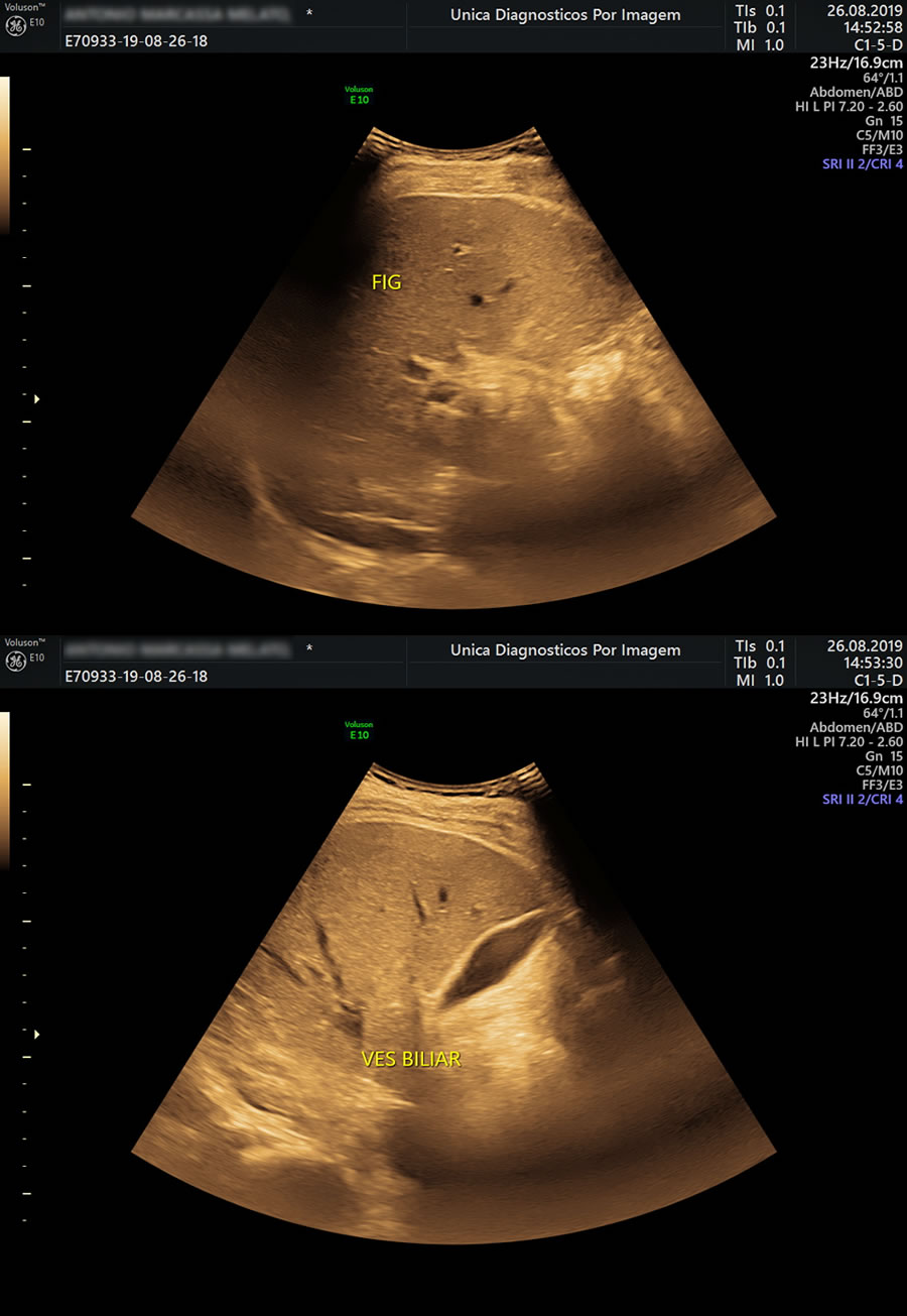 Ultrassom Abdominal com Pesquisa de Refluxo Gastroesofágico