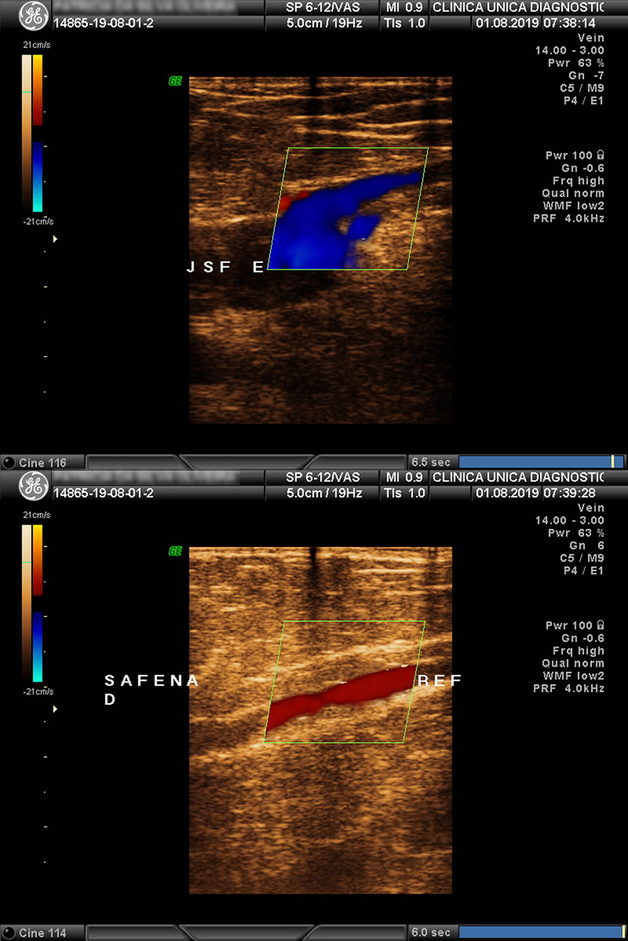 Doppler Venoso de Membros Inferiores