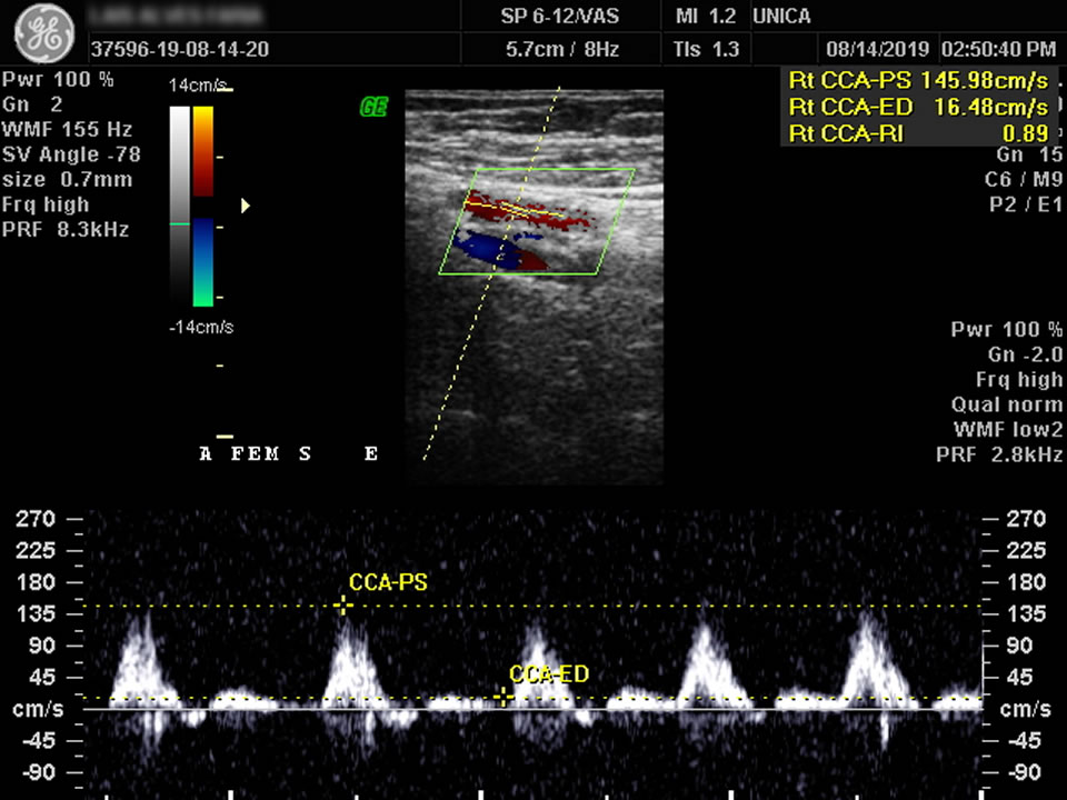 Doppler Arterial de Membros Inferiores