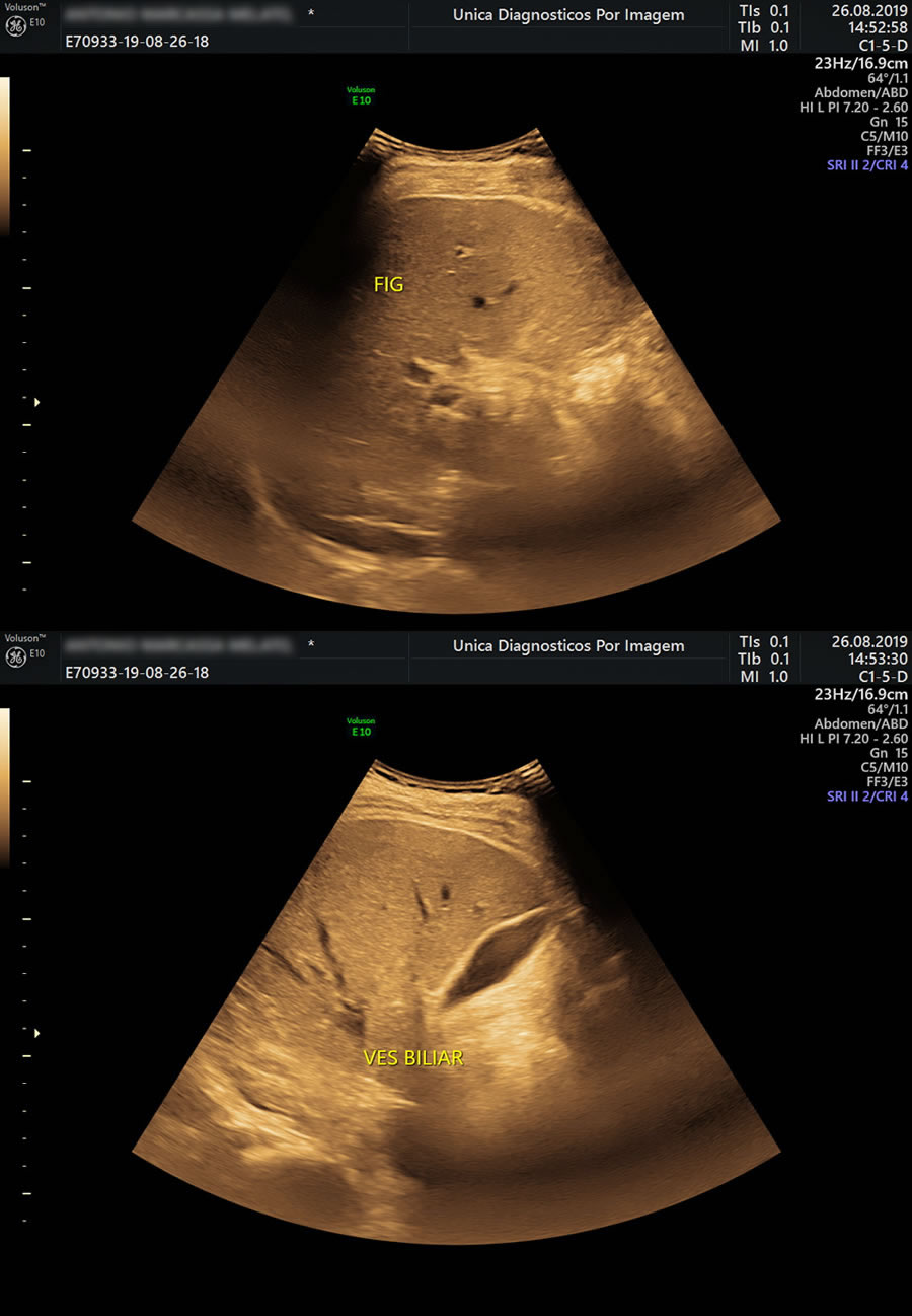 Ultrassom de Abdome Superior