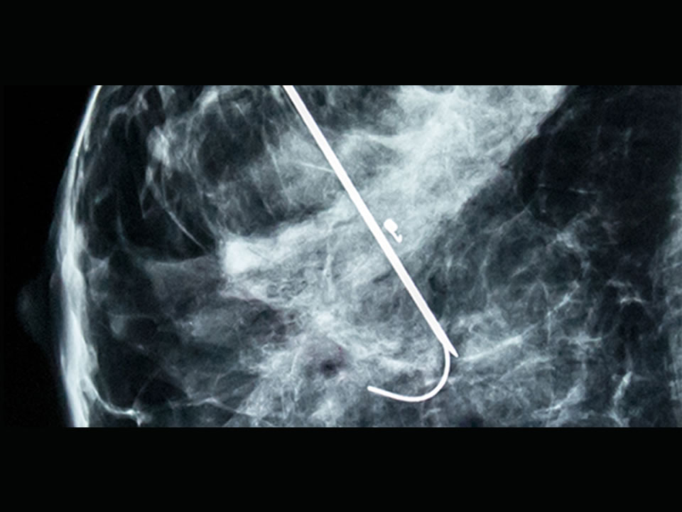 Core Biopsy de Mamas Guiada por Mamografia/Estereotaxia