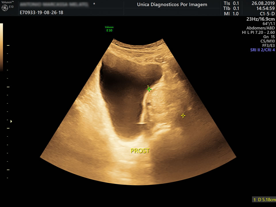 Ultrassom de Próstata pode ser realizado Via Abdominal ou Via Transretal