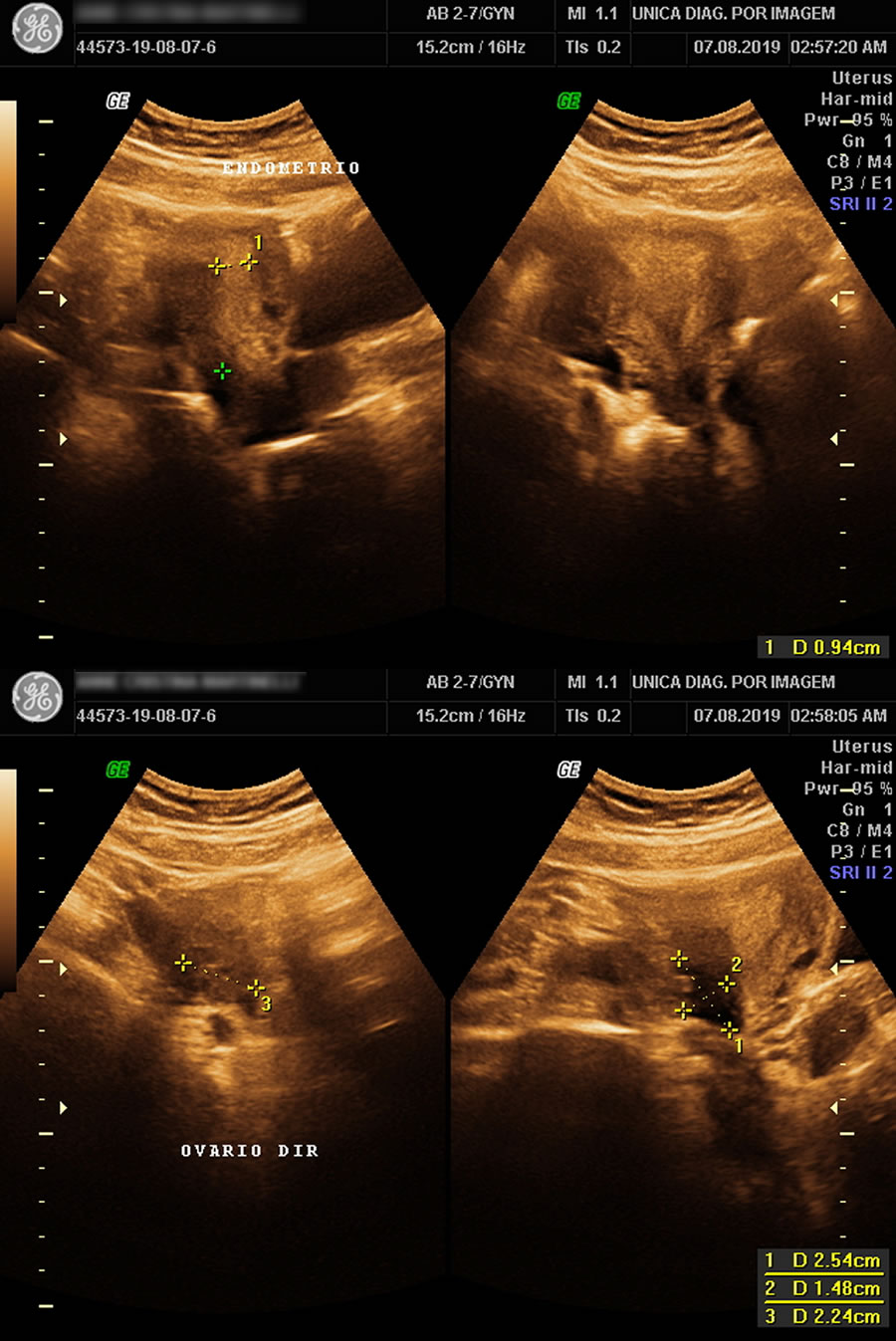 Ultrassom Pélvico Abdominal