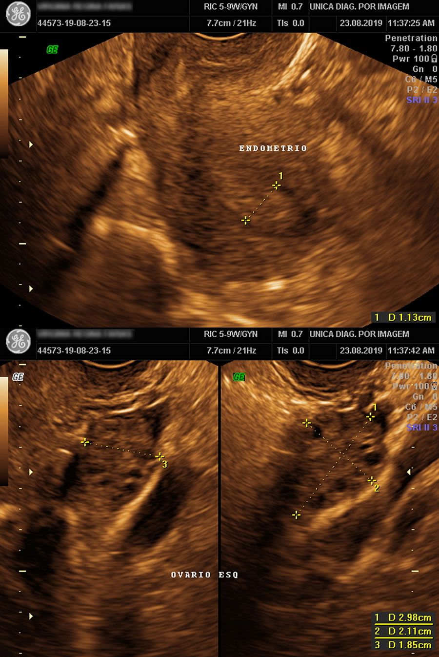 Ultrassom Pélvico Transvaginal para Controle de Ovulação