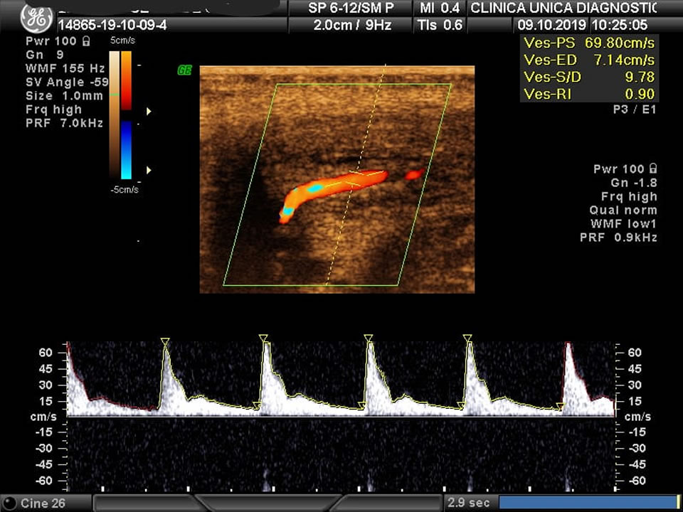 Ultrassom com Doppler auxiliando na Disfunção Erétil
