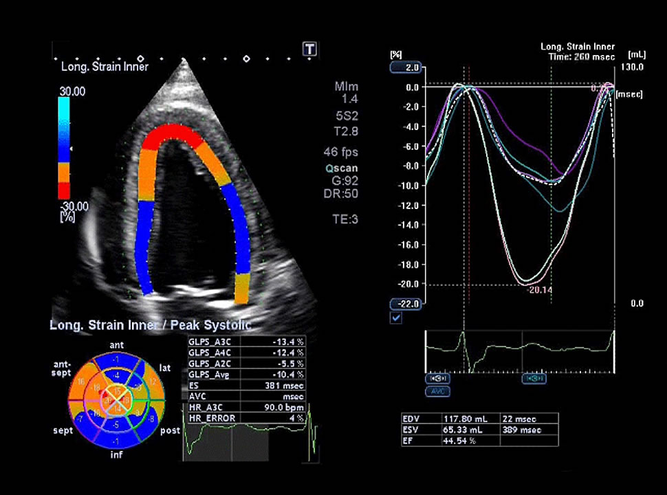 Ecocardiografia com Strain