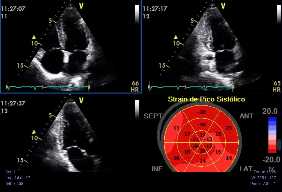 Ecocardiografia com Strain